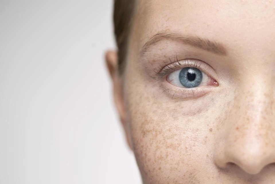Understanding Sun Damage: How UV Rays Alter Skin and How CryoPen Can Reverse It Wrexham