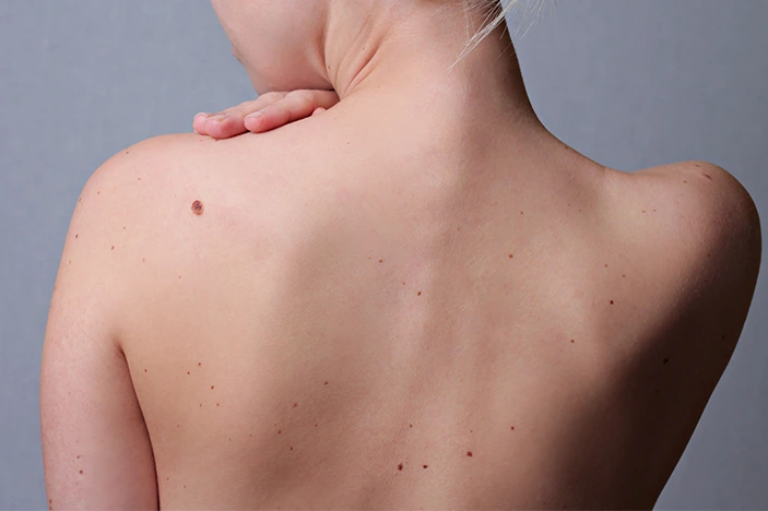 The Skin’s Healing Journey After CryoPen Sun Damage Treatment Wrexham