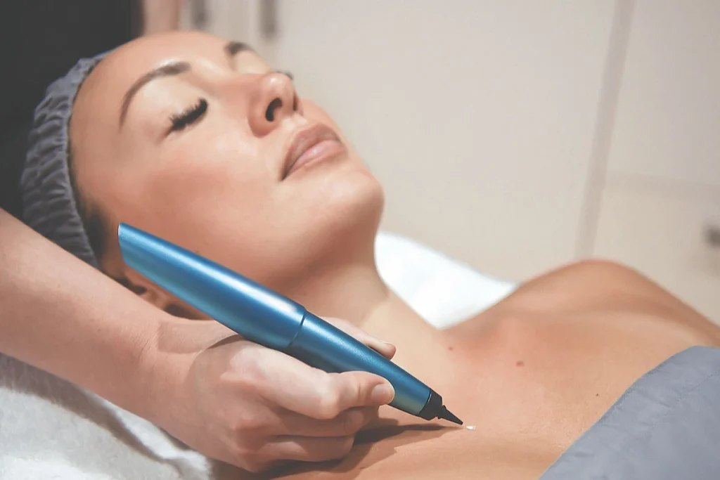 What is CryoPen Technology Wrexham? Wrexham