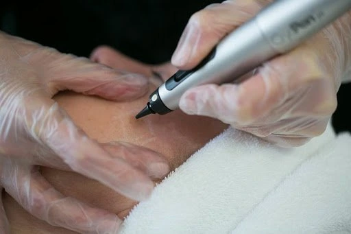 The CryoPen Technology Explained: How Extreme Cold Removes Sun-Damaged Skin Cells Wrexham