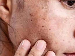 Why CryoPen Works Best for Isolated Sun Spots and Pigmentation Wrexham