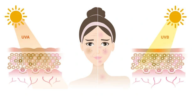 Understanding Sun Damage Wrexham : How Do UV Rays Cause Changes in the Skin? Wrexham