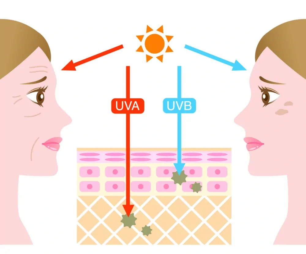 Understanding Sun Damage Wrexham - Why Should Sun Damage Be Treated Early? Wrexham